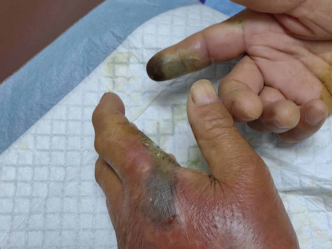 眼镜王蛇咬伤老人,家属拖两米多长的“凶手”冲进医院!“拎蛇就医”可取吗?